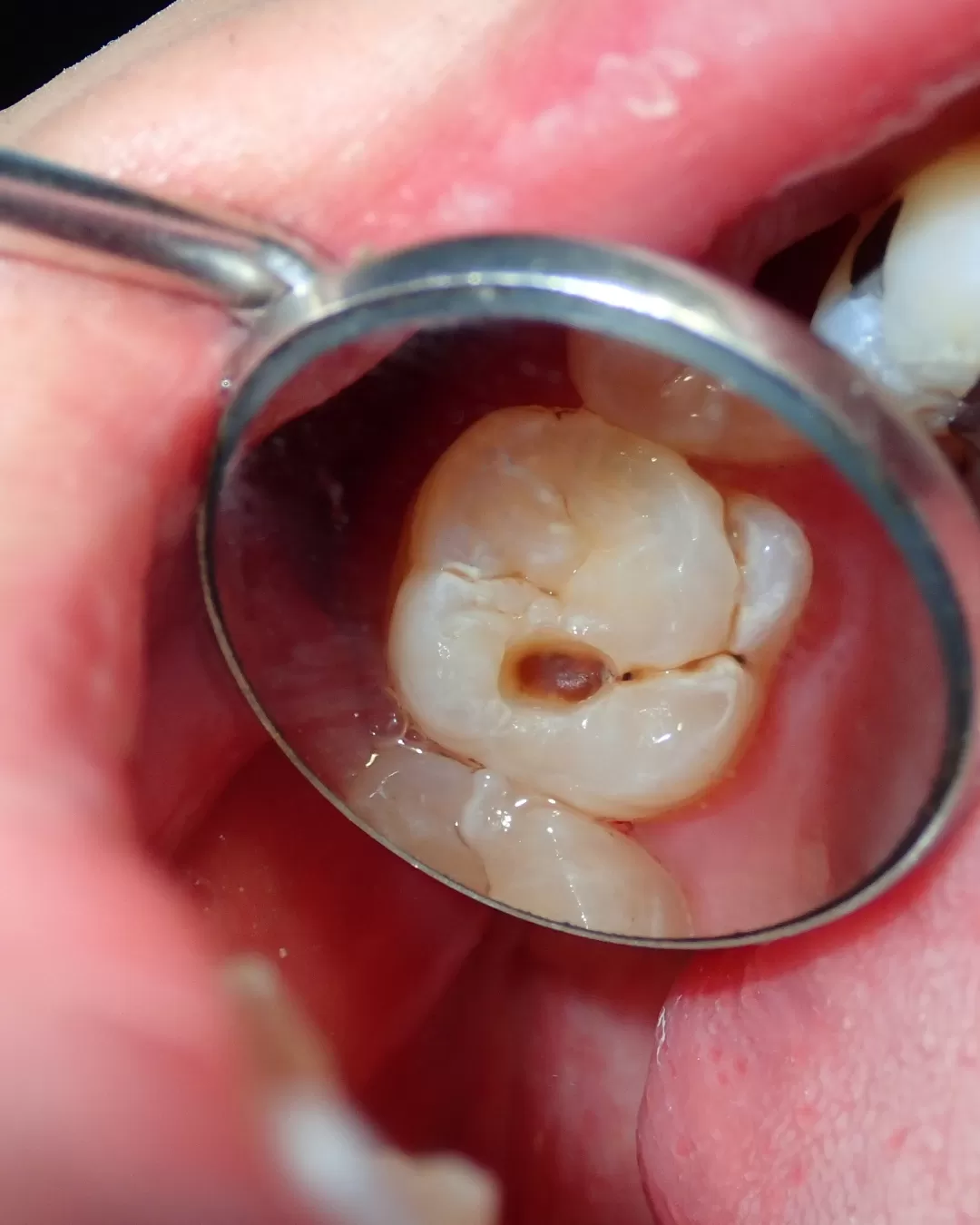 ¿Por Qué Es Importante Tratar una Caries a Tiempo?